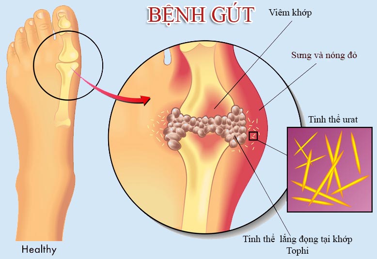 Giảm acid uric ở bệnh gout