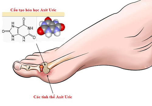 Dấu hiệu đầu tiên của bệnh gút là ở ngón chân cái do axit uric tích tụ tại ổ khớp gây viêm đau