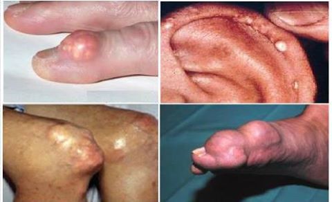 Vị trí xuất hiện hạt tophi trên cơ thể người bệnh gout