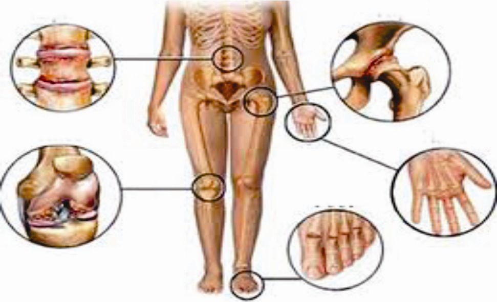 Những nguyên nhân và biểu hiện của bệnh gout tại các khớp