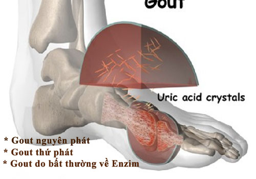 3 nguyên nhân gây bệnh gout: gout nguyên phát, gout thứ phát, gout do vất thường em zym
