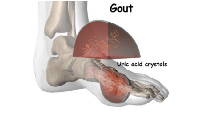 Hình ảnh bệnh gout - nguyên nhân gây bệnh gout