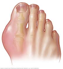Biểu hiện ban đầu của bệnh gout là sưng nóng đỏ đau ngón chân cái kèm theo sốt nhẹ vào ban đêm