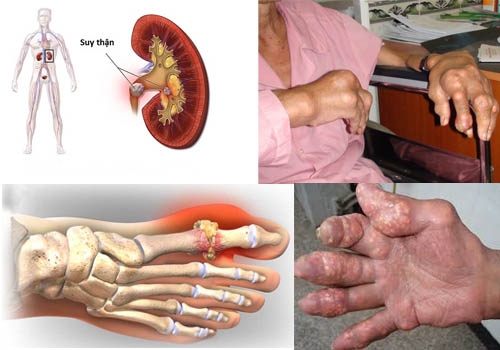 Biến chứng bệnh gout ở người cao tuổi
