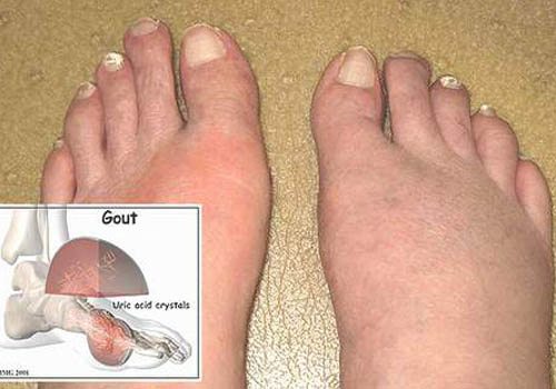 hình ảnh bệnh gout và thuốc điều trị bệnh gout