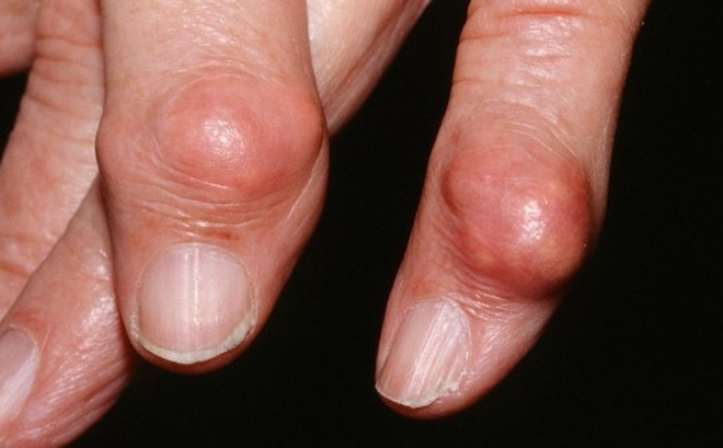 bệnh gout xuất hiện ở ngón tay