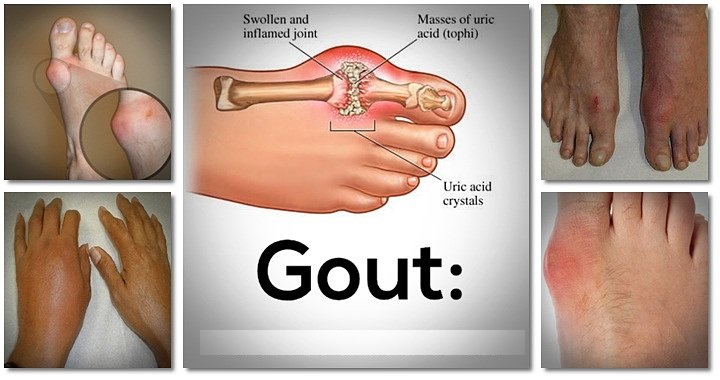 Acid uric tăng là “tiền đề” của bệnh gout
