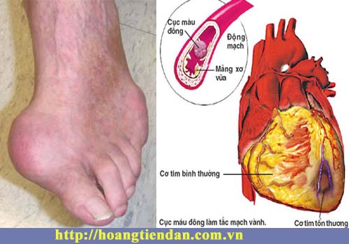 Bệnh gout gây nên các bệnh lý về tim mạch