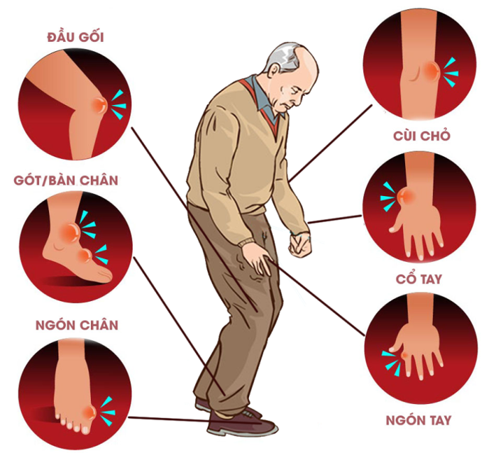 Những vị trí có thể xuất hiện cơn đau gout