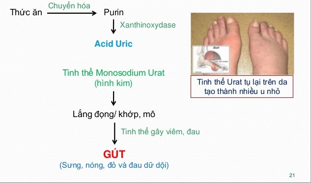 Sự lắng đọng acid uric hình thành bệnh gout