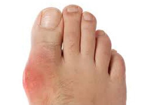 Biểu hiện ban đầu của bệnh gout - đau gốc ngón chân cái
