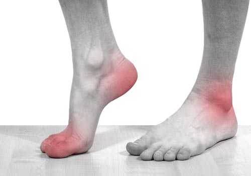 Đau ngón chân cái - hiểu hiện ban đầu của bệnh gout