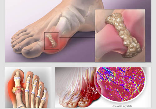Triệu chứng bệnh gout thường gặp