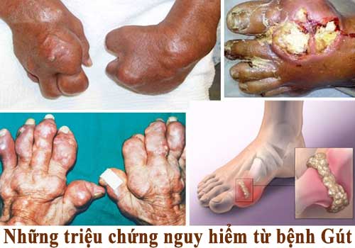 Hình ảnh hạt tophi - Triệu chứng bệnh gout mãn tính