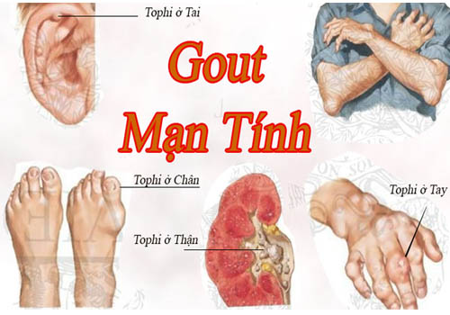 Triệu chứng gây đau của bệnh gout