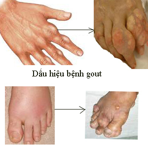Dấu hiệu nhận biết bệnh gout